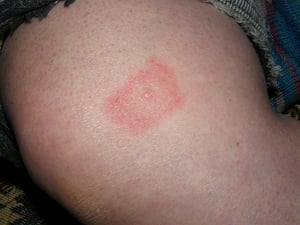 Lyme Disease Rash