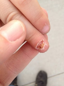 Finger Smashed in Door